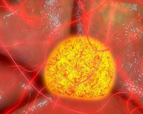 多囊卵巢患者备孕饮食与助孕方式选择指南